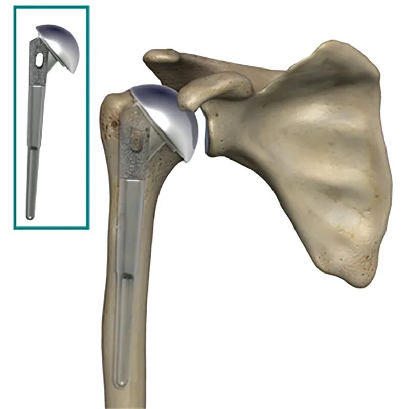 Эндопротез плечевого сустава. Однополюсное эндопротезирование плечевого сустава. Реверсивный эндопротез. Эндопротез плечевого сустава Тотальный реверсивный. Операция по замене плечевого сустава