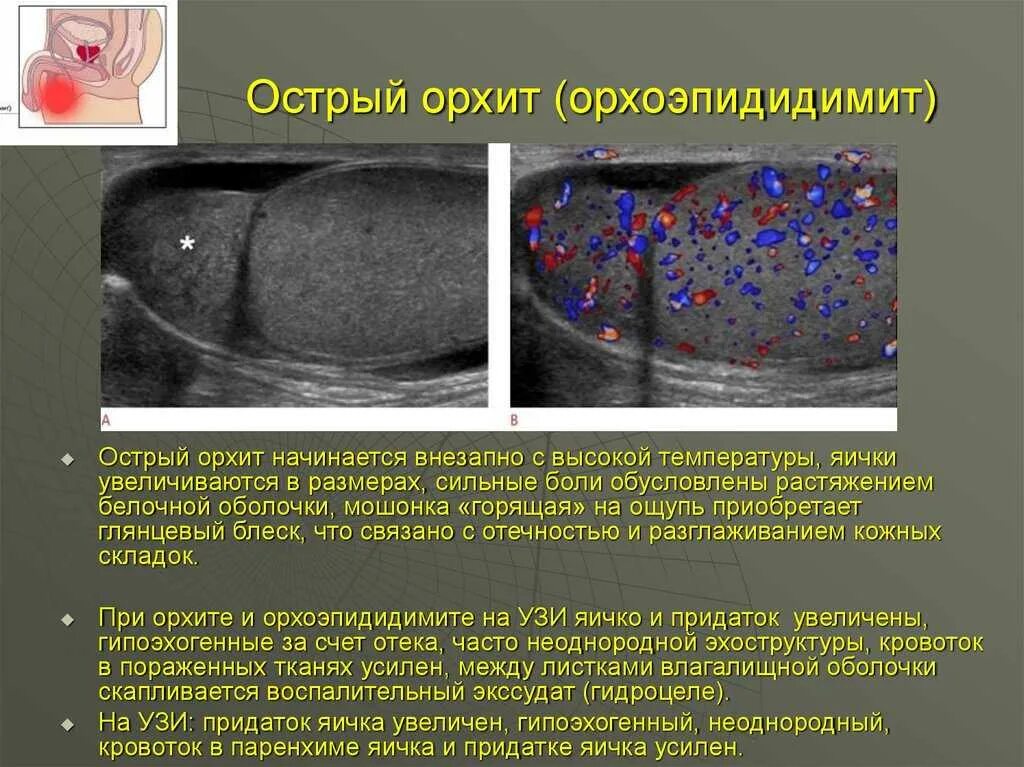 Орхит симптомы