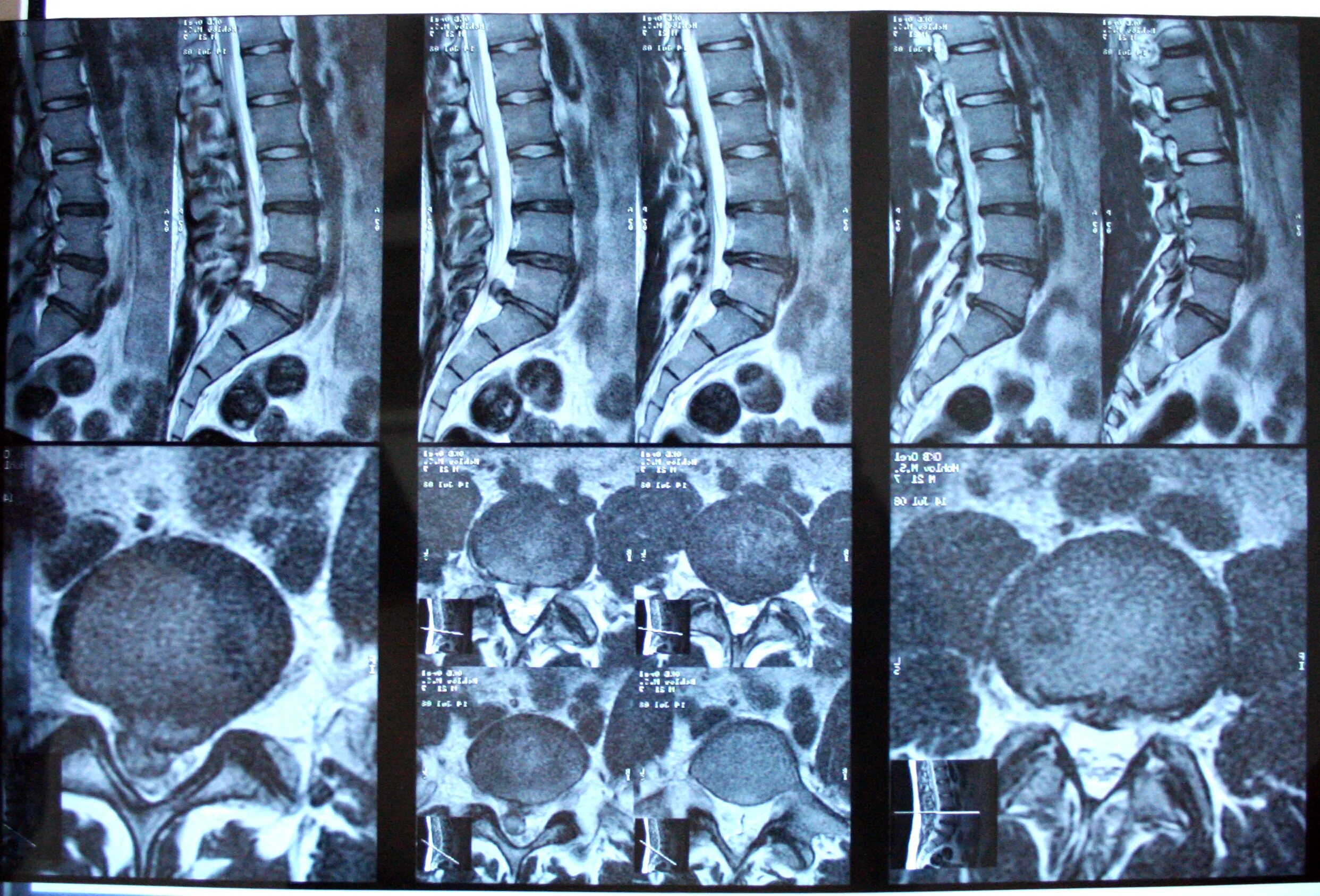 Мрт пояснично-крестцового отдела позвоночника. Кт пояснично-крестцового отдела позвоночника. Мрт позвоночно крестцового отдела. Деформирующий спондилез на кт. Можно делать кт позвоночника