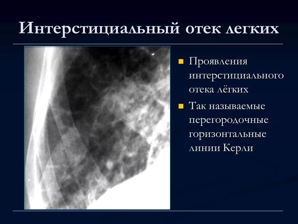 Отек легких сопровождается. Интерстициальный отек легких клиника. Альвеолярный отек легкого рентген. Отек легких линии Керли.