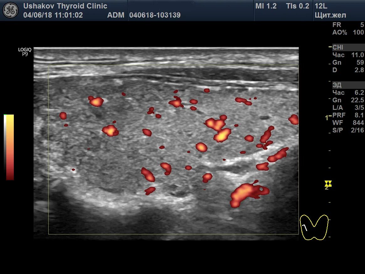 Курс обучения узи. Методика ультразвукового исследования щитовидной железы. Метод исследования щитовидной железы УЗИ. УЗИ щитовидной железы подготовка. Подготовиться к УЗИ щитовидной железы.