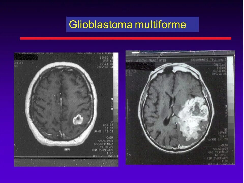 Глиобластома сколько живут. Мультиформенная глиобластома. Глиобластома гистология. Полиморфная глиобластома. Глиобластома головного мозга.