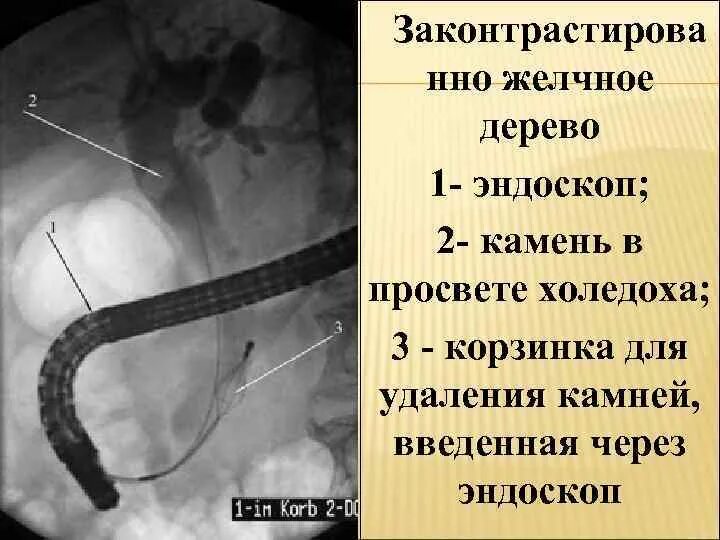 Удаление камня через проток. ЭРХПГ поджелудочной железы.