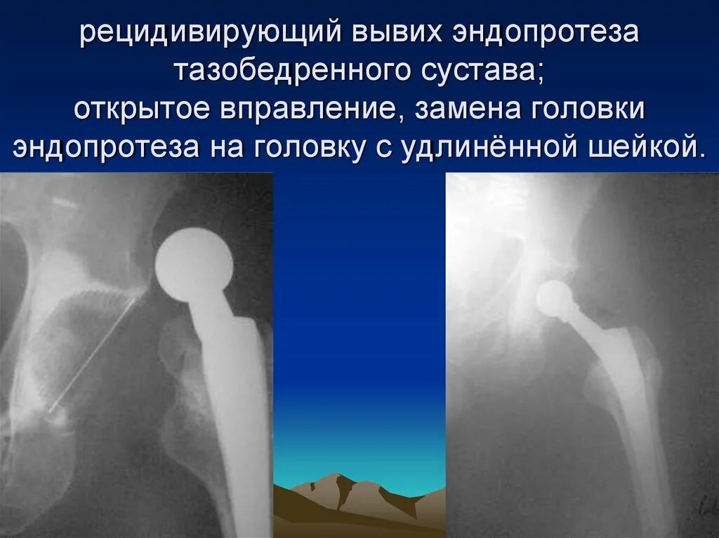 Осложнения после эндопротезирования тазобедренного сустава. Подвывих эндопротеза тазобедренного. Вывих протеза тазобедренного сустава рентген. Эндопротез тазобедренного сустава вывих.