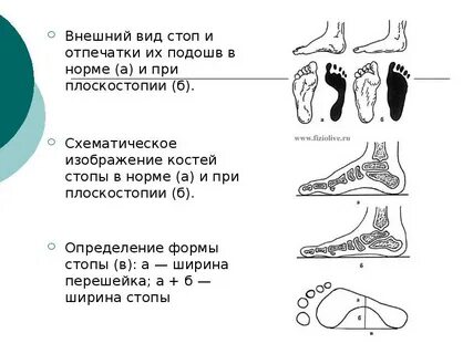 Характеристика плоскостопия москва