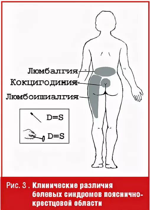 Синдром люмбалгии что это такое. Люмбоишиалгия поясничного отдела. синдром люмбоишиалгии поясничного отдела позвоночника. что такое люмбалгия пояснично-крестцового. клинические проявления люмбоишиалгия.
