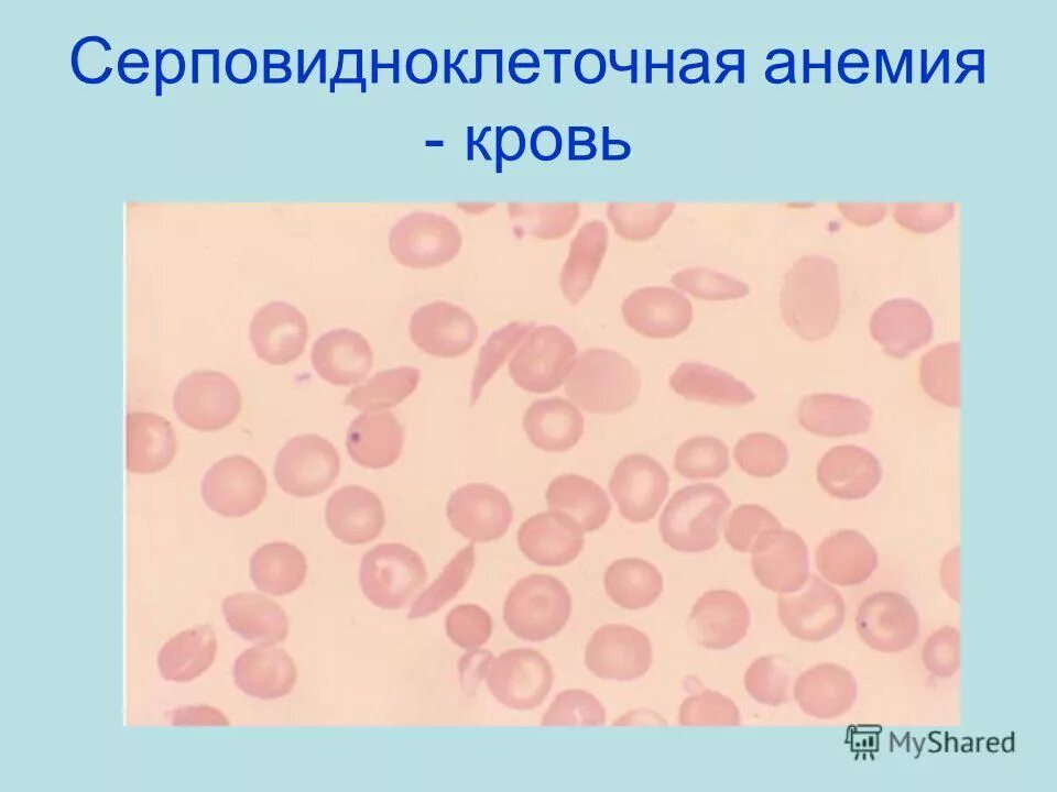 Серповидноклеточная анемия какая. Серповидноклеточная анемия гистология. Серповидно клеточная анемия эритроциты. Клинические признаки серповидноклеточной анемии. Гемолитические анемии серповидноклеточная анемия.