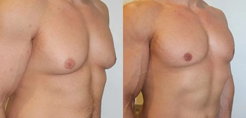 Гинекомастия пролиферирующая. Диффузорная гинекомастия. Втянутостый сосок у мужчин. Операция по удалению сосков. Операция по удалению сосков.