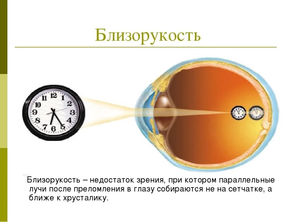 Точка лежащая зрение. Дефекты зрения близорукость. Близорукость недостаток зрения при котором параллельные лучи. Зрение с точки зрения физики. Близорукость сообщение.