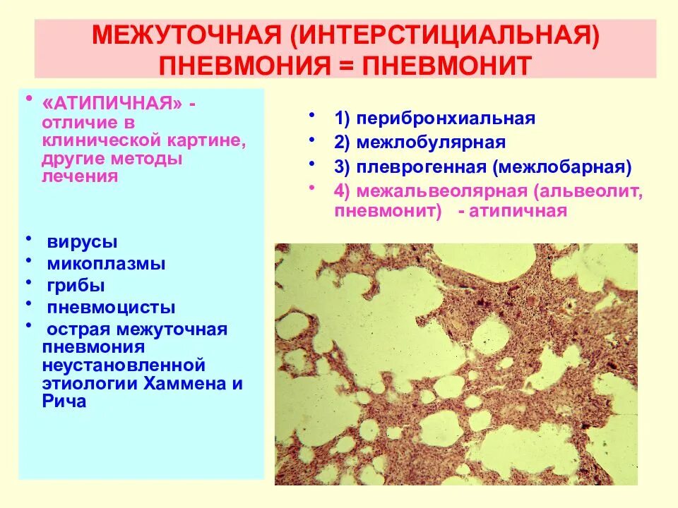 Чем отличается пневмония от ковида 19. Острая интерстициальная пневмония этиология. Пневмонит отличие от пневмонии. Патогенез острой интерстициальной пневмонии. Интерстициальная интерстициальная пневмония.