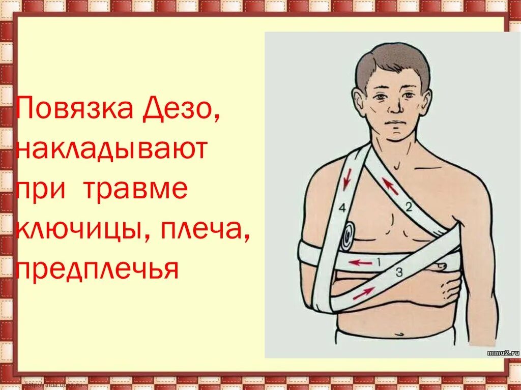 Технику наложения повязки Дезо.. Перевязка плеча Дезо. Повязка Дезо накладывается. Перелом ключицы повязка Дезо.