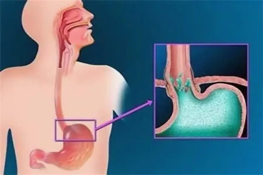 Соляная кислота в пищеводе