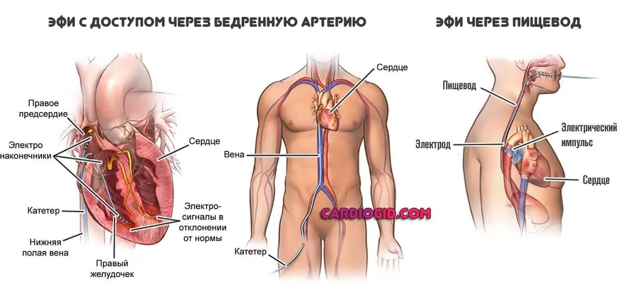 Рча сердца после операции. Внутрисердечное электрофизиологическое исследование сердца. эфи рча сердца что после операции. эндокардиальное эфи.