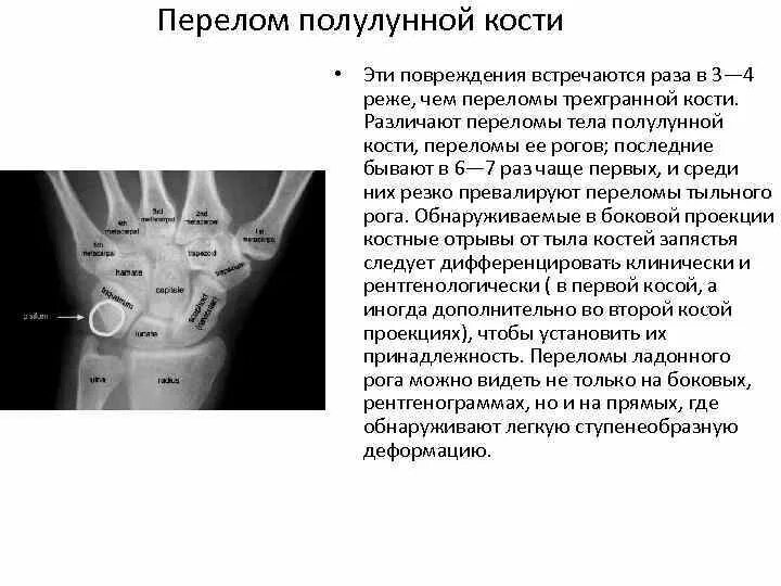Перелом лучезапястного сустава лечение. Переломы полулунной кости рентгенологически. перелом гороховидной кости запястья. полулунная кость кисти перелом. срок иммобилизации при переломе ладьевидной кости кисти.
