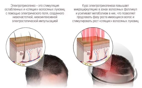 Как разбудить волосы на голове. Спящие волосяные луковицы. спящие волосяные луковицы на голове. спящие луковицы волос на голове.