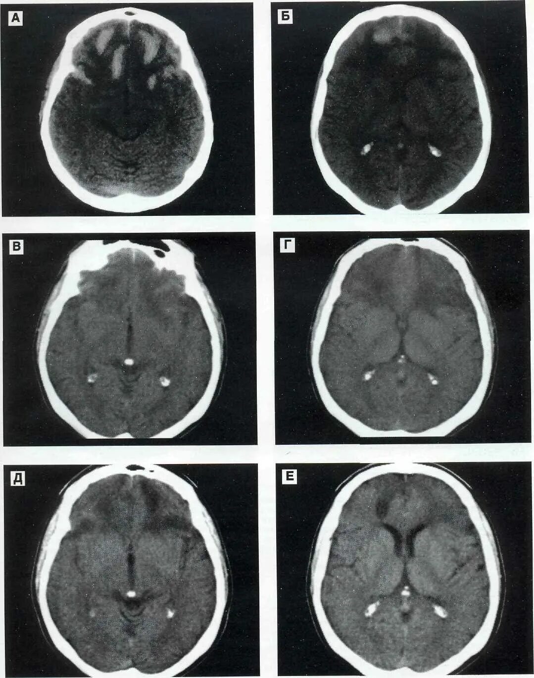Образование в лобной доле. Гиперденсивный очаг головного мозга. Гиперденсивный очаг в головном мозге кт.