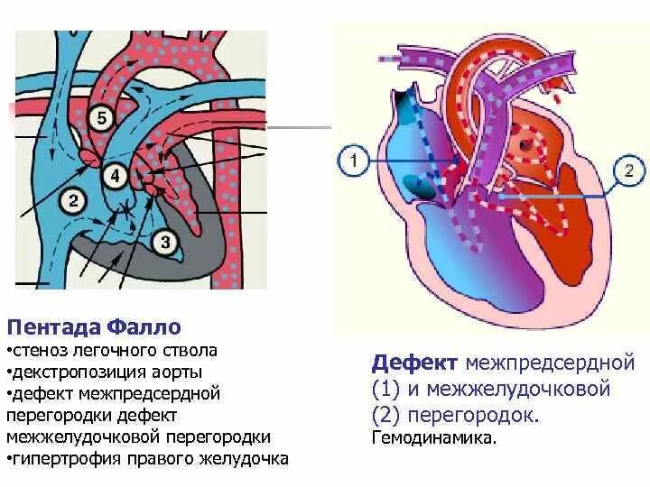 Трехкамерное сердце с перегородкой в желудочке. Трехкамерное сердце без межжелудочковой перегородки у кого. Трехкамерное сердце без межжелудочковой перегородки у кого. Дефект межжелудочковой перегородки сердца у детей. Трехкамерное сердце без межжелудочковой перегородки у кого.