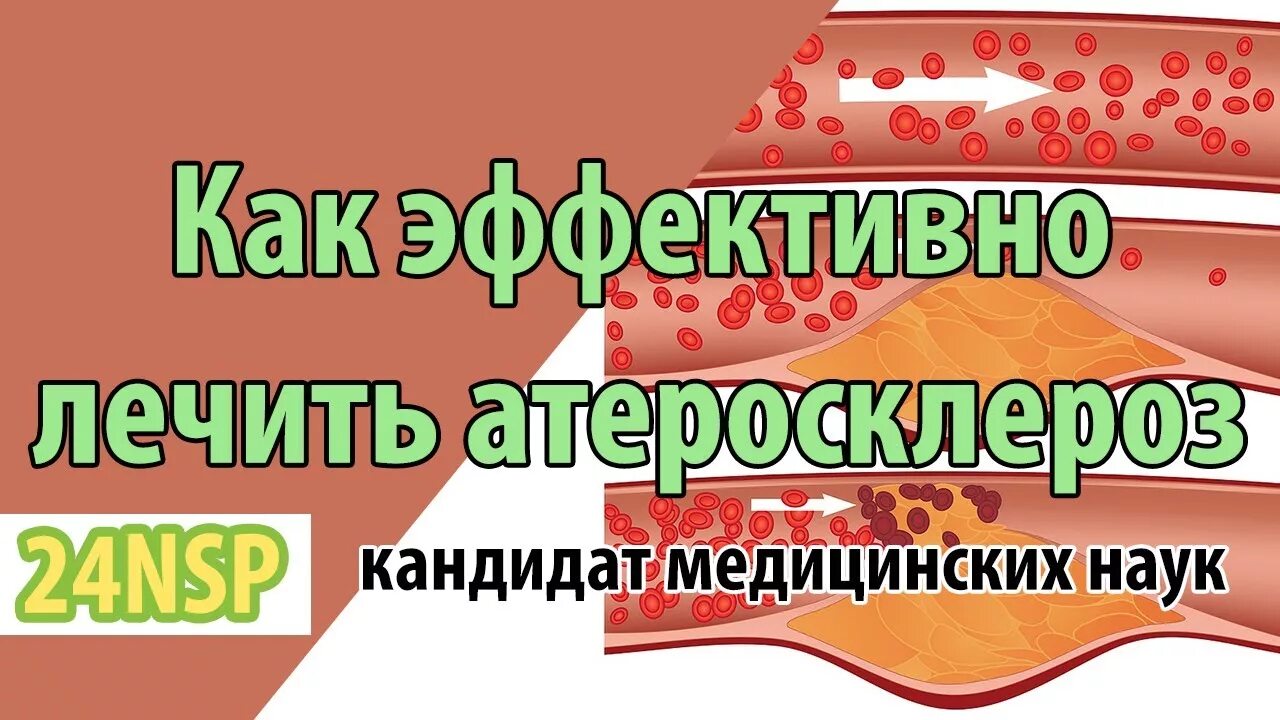 Лечим атеросклероз сосудов ног. Народные средства от атеросклероза.