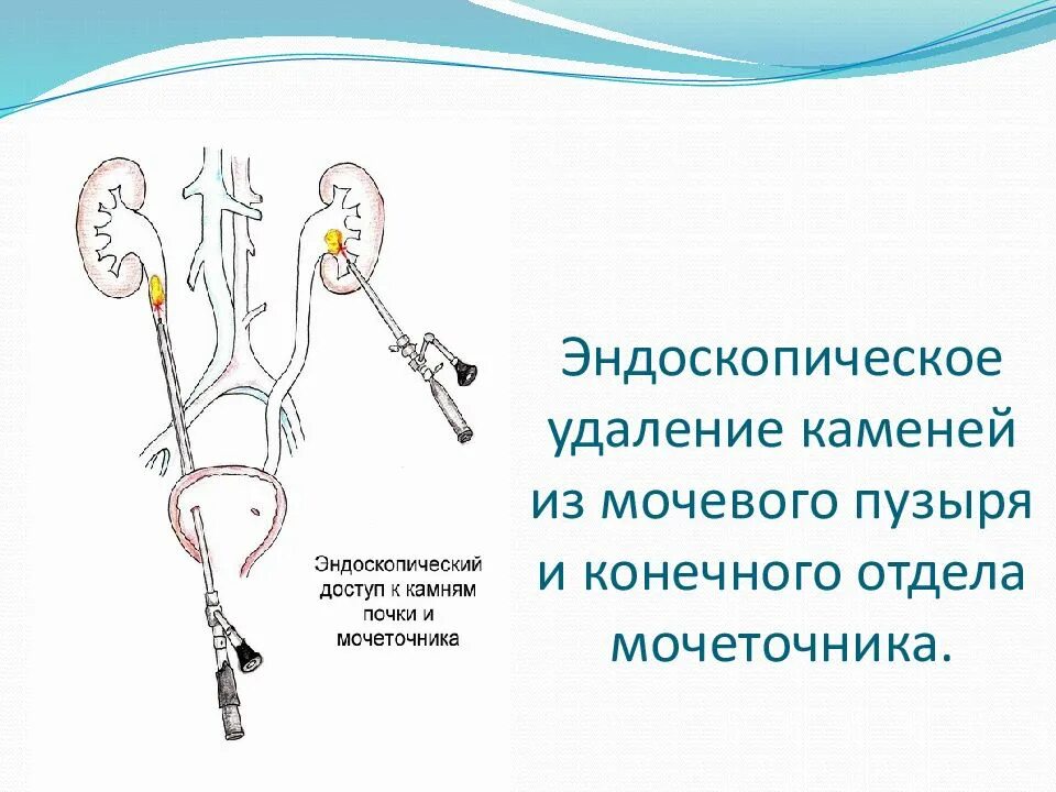 Катетер из мочеточника. Катетеризация мочеточника. Катетер стент мочеточника.