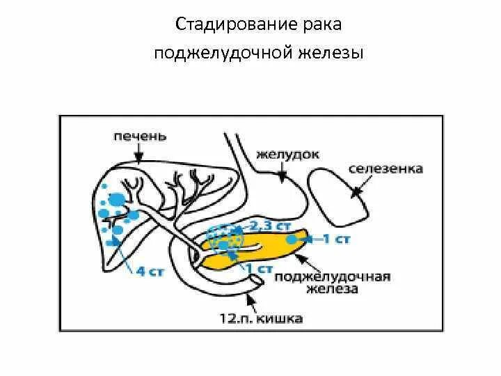 4 стадия поджелудочной железы сколько живут. Муковисцидоз поджелудочной железы. Муковисцидоз и поражение поджелудочной железы. Поражение поджелудочной железы при муковисцидозе. Онкология поджелудочной железы.