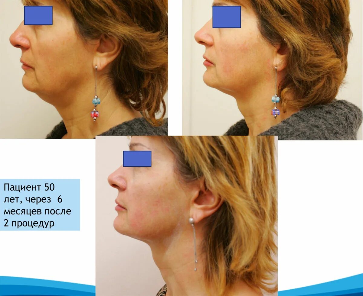 Smas-лифтинг на аппарате ultraformer. Смас лифтинг ультраформер 3. Ультраформер отзывы фото. Smas лифтинг. Ультразвуковой смас лифтинг ультраформер 3.