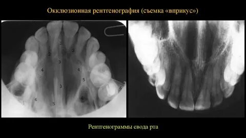 Внутриротовая рентгенография