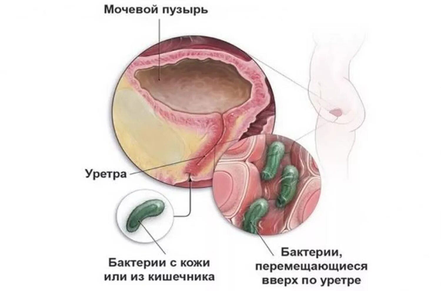 Болезни мочевого пузыря у женщин симптомы лечение. Мочевой пузырь у женщин. воспаление мочевого пузыря. цистит воспаление мочевого пузыря.