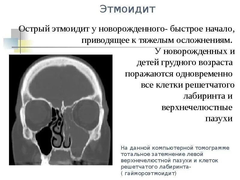 Сфеноидит симптомы. Этмоидит (воспаление решетчатой пазухи). этмоидит на рентгене описание. симптомы синусита решетчатого лабиринта.
