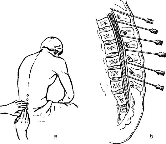 Паравертебральная поясничная блокада. Спинальная анестезия пункция. Люмбальная пункция схема. Методика спинномозговой пункции. Спинальная анестезия топографическая анатомия.