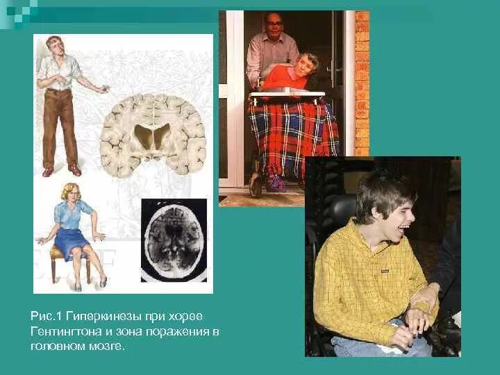 Хорея хантингтона. Хорея гентингтона (болезнь гентингтона). хорея гентингтона частота встречаемости. синдром хорея хантингтона. хорея гентингтона кариотип.