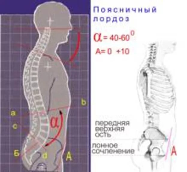 Угол поясничного лордоза норма. Гиперлордоз поясничного отдела норма. Лордоз поясничного отдела позвоночника что это степени. Измерение лордоза поясничного отдела рентген.