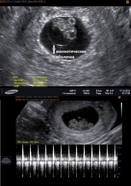 Акушерские и эмбриональные недели. УЗИ на 8 неделе беременности акушерской. Снимок УЗИ эмбриона на 8 неделе беременности. 9 Недель акушерской беременности снимки УЗИ. Как выглядит плод в 8 недель на УЗИ.