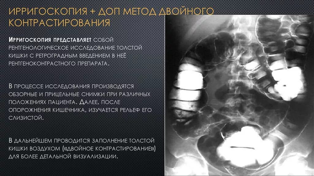Ирригоскопия с двойным контрастированием. Ирригоскопия методом двойного контрастирования. двойное контрастирование толстой кишки рентген. метод рентгенологического исследования толстой кишки. двойное контрастирование при ирригоскопии.