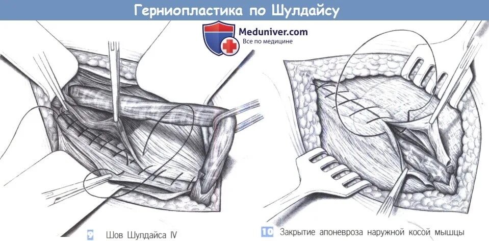 Шолдайсу грыжесечение. Пластика грыжи по Шолдайсу. Пластика по Шолдайсу при паховой. Паховая грыжа по Шолдайсу. Лихтенштейн операция паховая