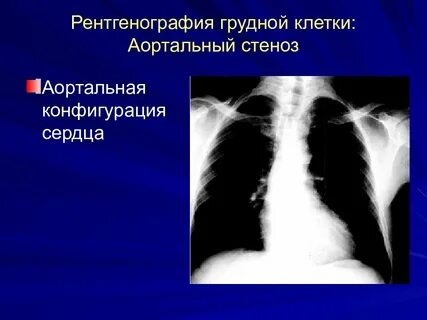 Стеноз легких