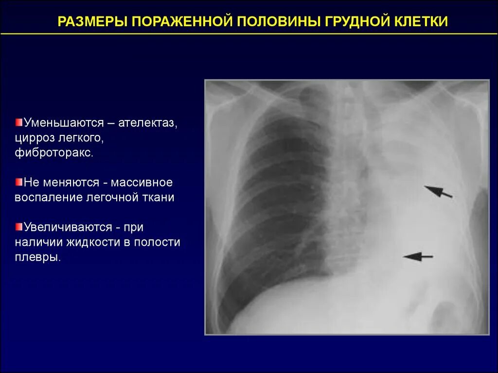 Шварты в легких это. Фиброторакс с циррозом легкого. Плеврогенный цирроз легкого. Фиброторакс шварты. Частичный ателектаз на рентгене.