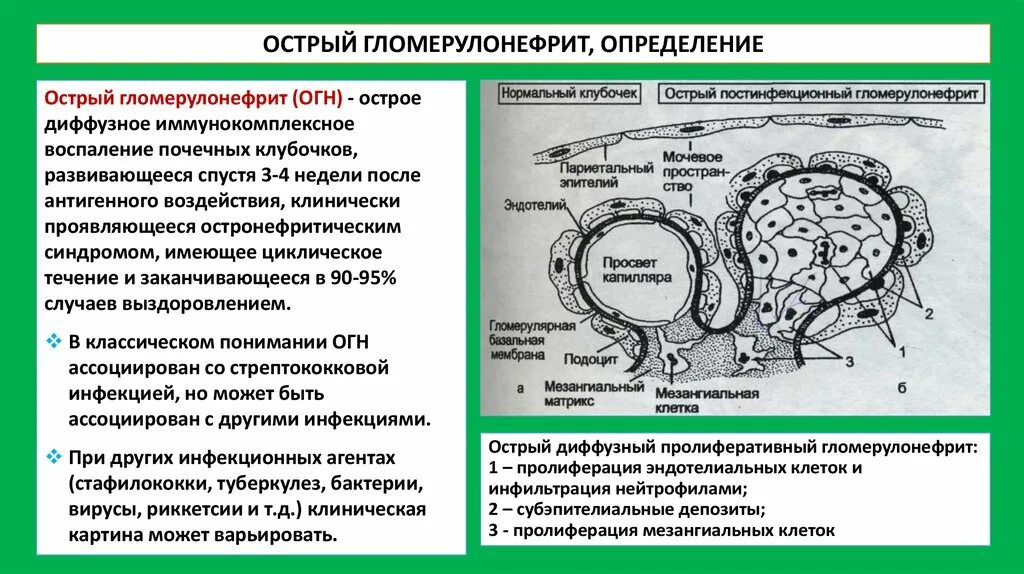 Хронический постстрептококковый гломерулонефрит. Морфологические проявления острого гломерулонефрита. Патогенез острого гломерулонефрита. Гломерулонефрит развивается. Поражение клубочков почек