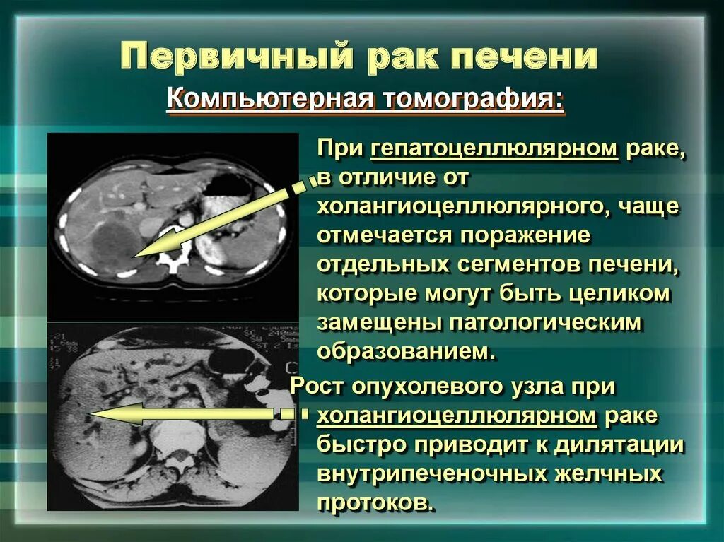 Признаки метастаз при раке. Новообразования в печени на кт. Первичные злокачественные опухоли печени.