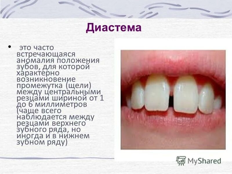 Почему между зубами щель
