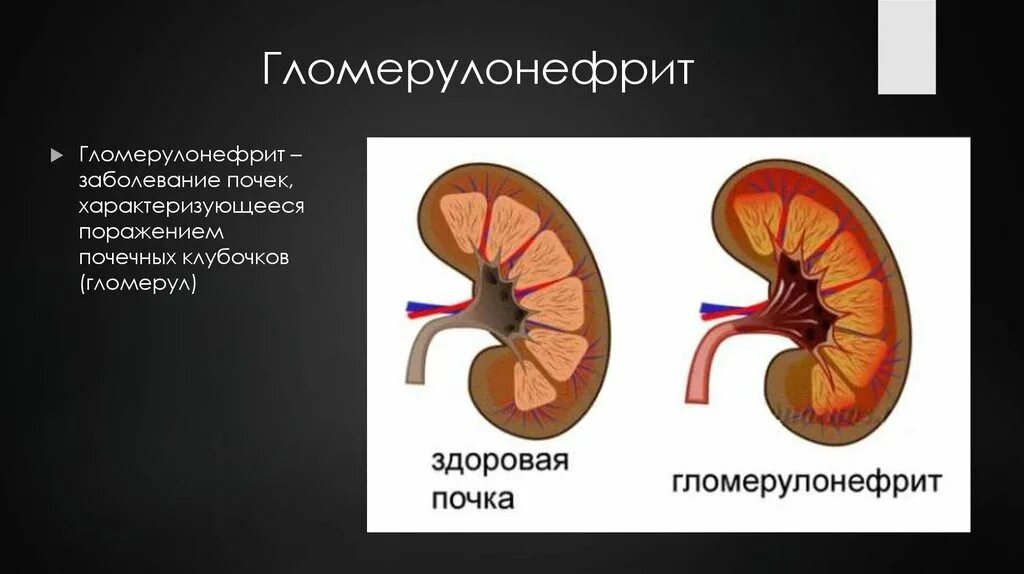 Заболевание почек гломерулонефрит. Поражение почек при гломерулонефрите. Почка пораженная гломерулонефритом. Здоровая почка и хронический гломерулонефрит. Гломерулонефрит – заболевание.