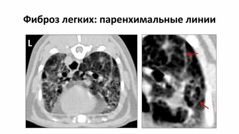 Фиброз легких причина лечение