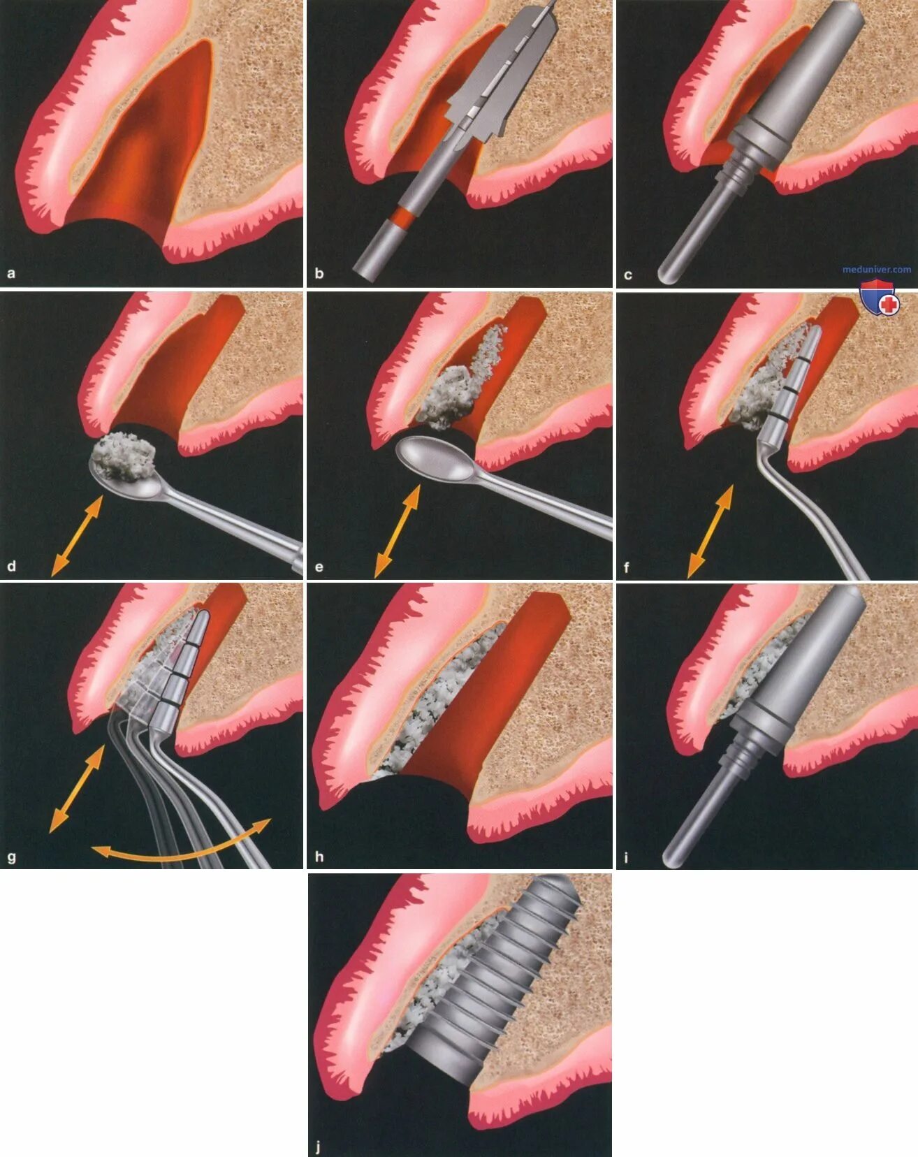 Через сколько можно кушать после удаления зуба. Удалили зуб через сколько можно кушать. Сколько времени после удаления имплантов. Имплантация зубов сразу. Сколько времени после удаления имплантов.