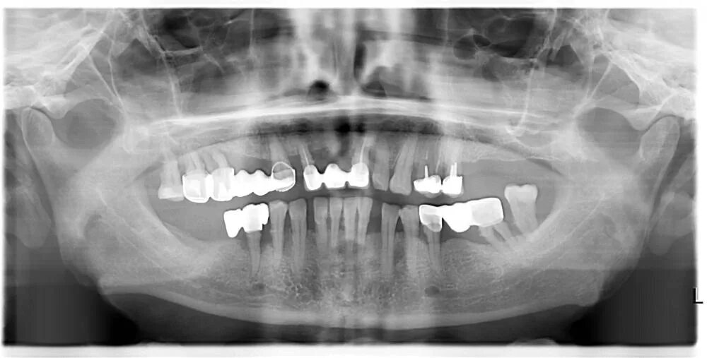 Курят ли после имплантации. Курят ли после имплантации. Ирис импланты. Курят ли после имплантации. Курят ли после имплантации.