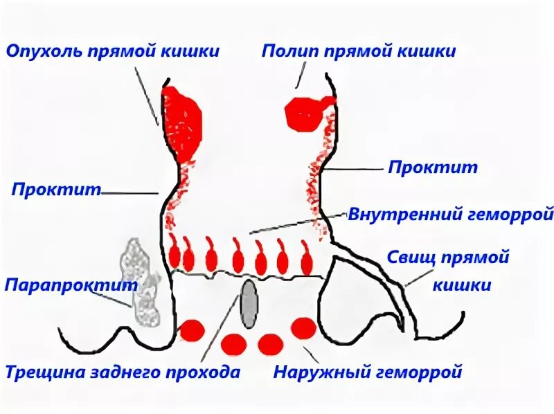 Трещина в кишечнике. Воспаление прямого кишечника. Воспаление отростка прямой кишки.