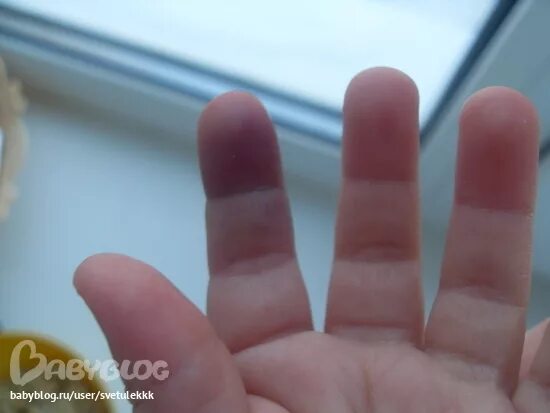 Подробно о том, как сломать палец на руке или ноге