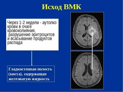 Прогнозы после инсульта форум