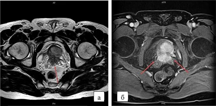 Кт малого таза с контрастом у мужчин. Предстательная железа мрт сагитал. Карцинома мрт предстательной железы. Тератома малого таза мрт. Простата и семенные пузырьки на мрт.
