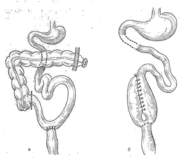 Субтотальная резекция толстой кишки. Субтотальная колэктомия с илеоректальным анастомозом. Колэктомия с формированием илеоректального анастомоза. Резекция толстой кишки с анастомозом. Операция желудка кишечника