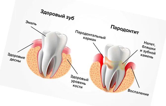 Плазмолифтинг в стоматологии. Плазмолифтинг стоматология десна. плазмолифтинг лунки удаленного зуба. плазмолифтинг зубов в стоматологии.
