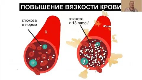 Мочеиспускание при диабете 2